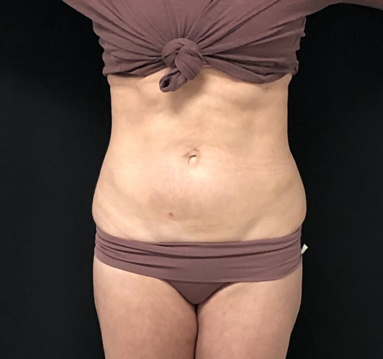 Picture of after belly fat treatment in mobile