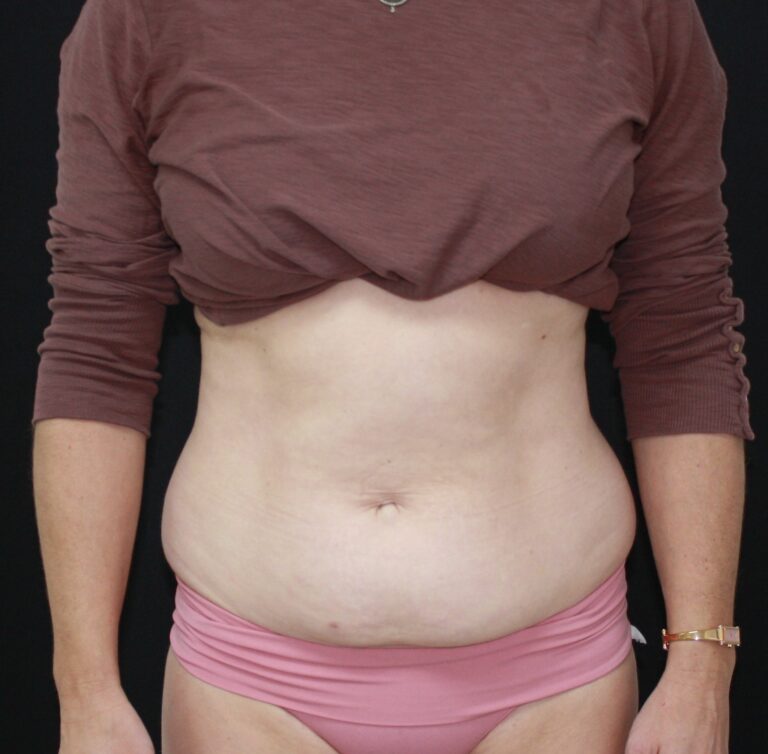Picture of belly fat treatment in mobile